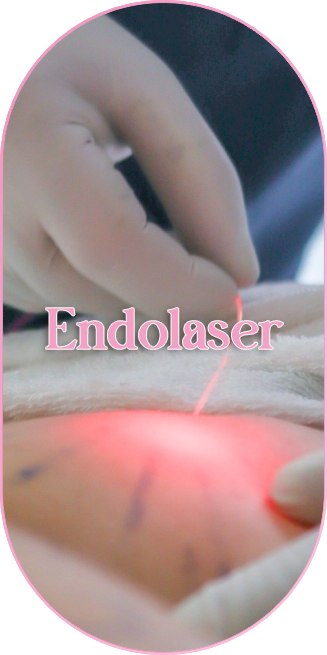 Endolaser